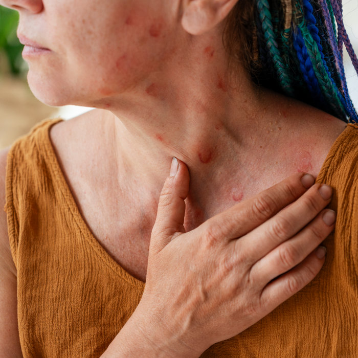 Skin Condition Neurodermatitis Study