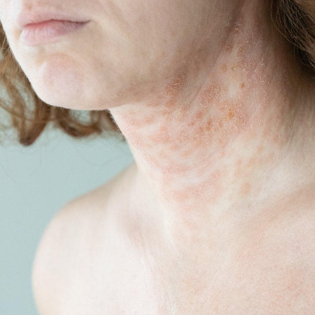 Tired of Itching and Skin Flares v2