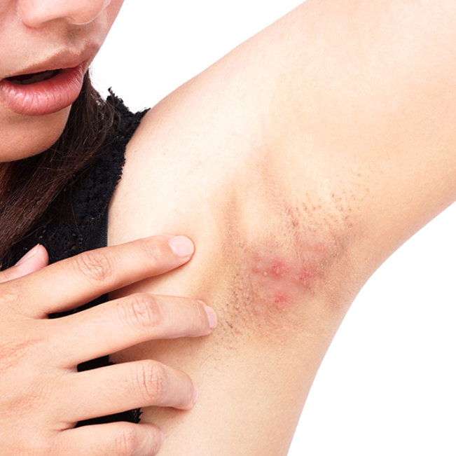 item-2-Hidradeinitis