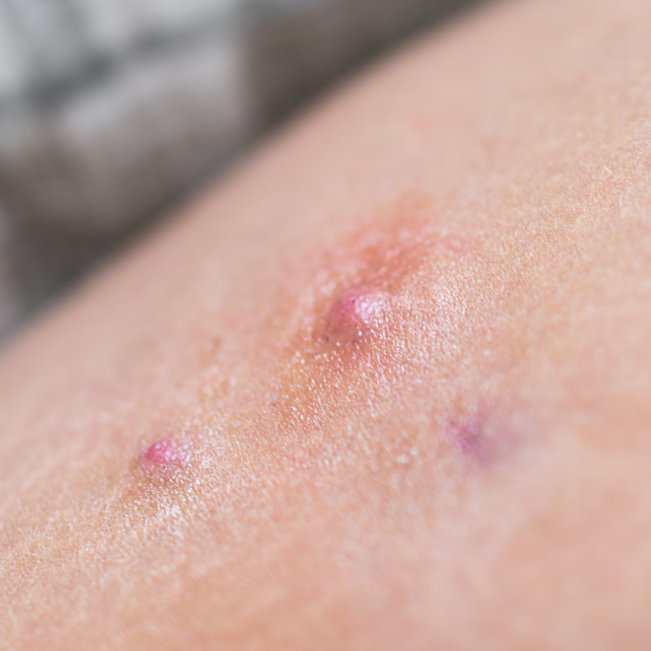 item-4-Hidradeinitis