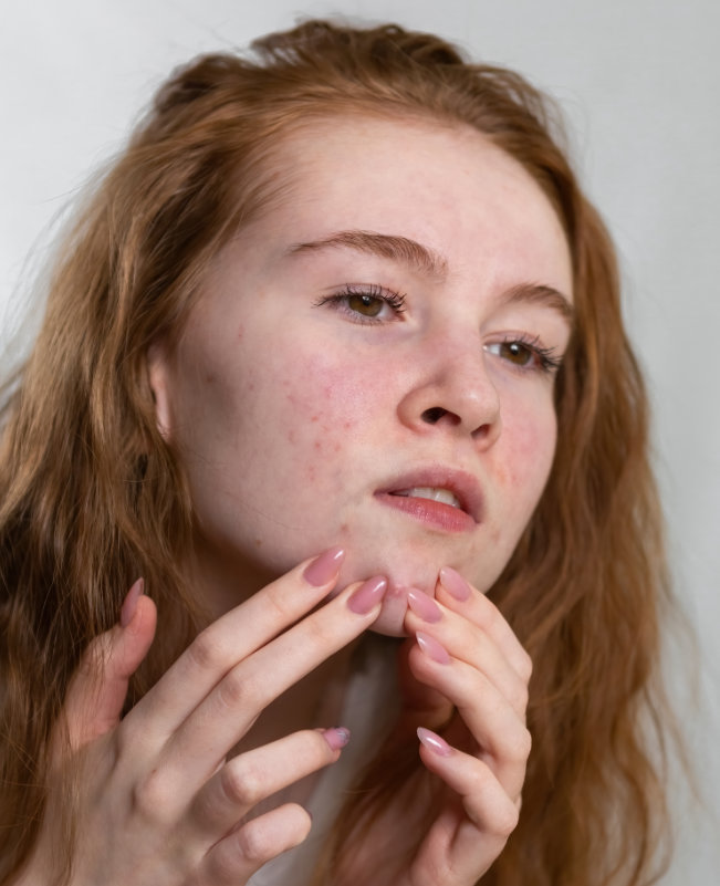 Acne vaccine as a solution