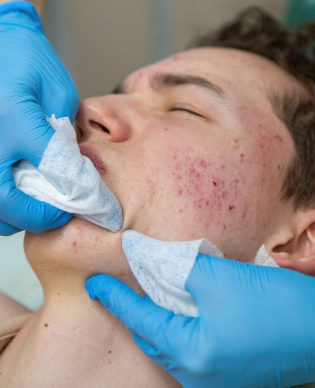 Inflammatory acne vaccine