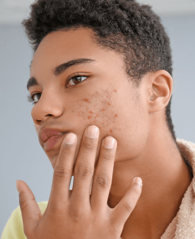 Recurrent breakouts Acne